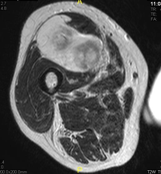 Frontiers | Cysteine-specific 89Zr-labeled anti-CD25 IgG